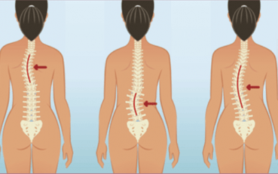 Escoliosis y pilates