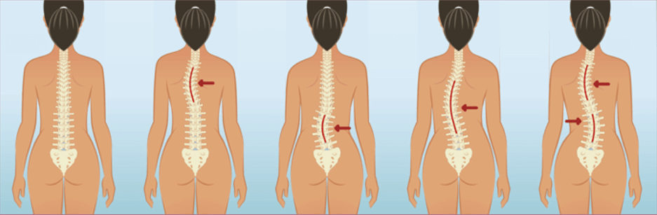 Escoliosis y pilates